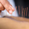 acupuncture